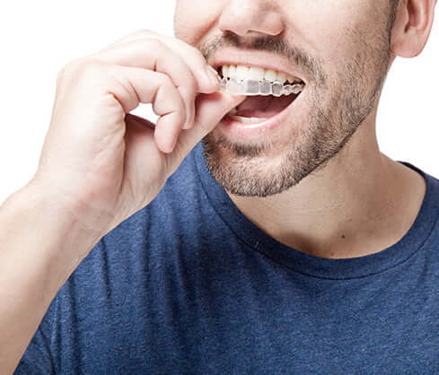 man putting clear aligner in mouth