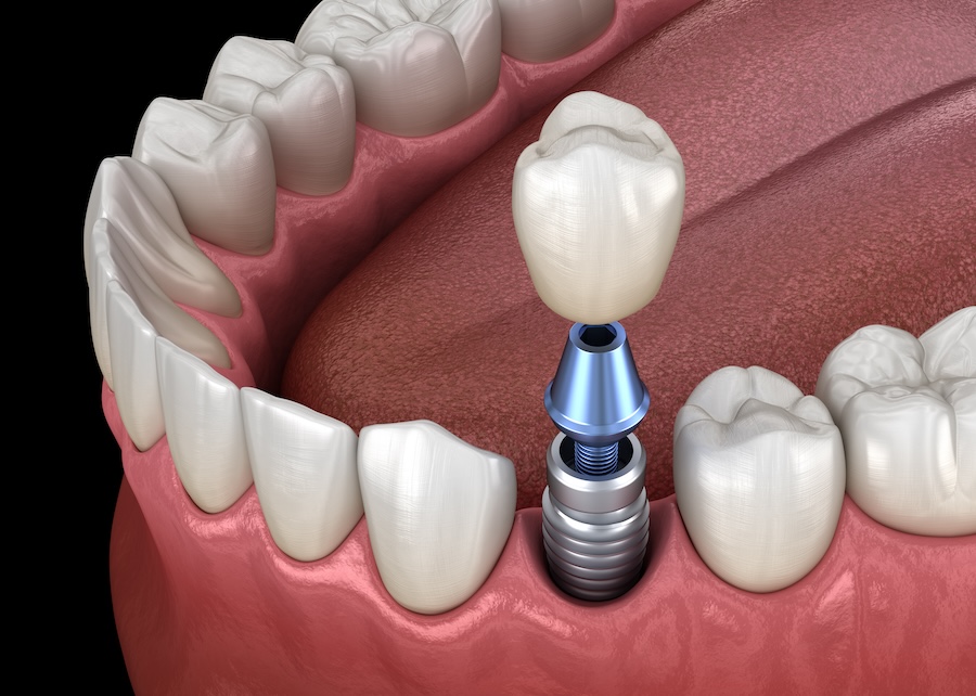 dental implants, Bolt Family Dental, Brownsburg dentist, Dr. Anne Wilmore, dental care, tooth replacement, oral health, implant surgery, dental hygiene