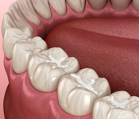 illustration of a composite filling